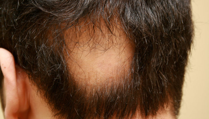alopecia2